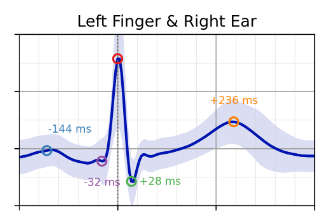Finger-to-Ear ECG Pulsewave